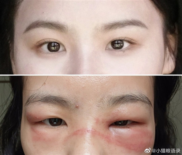 我的脸被隐翅虫毁容了！千万小心“会飞的硫酸”